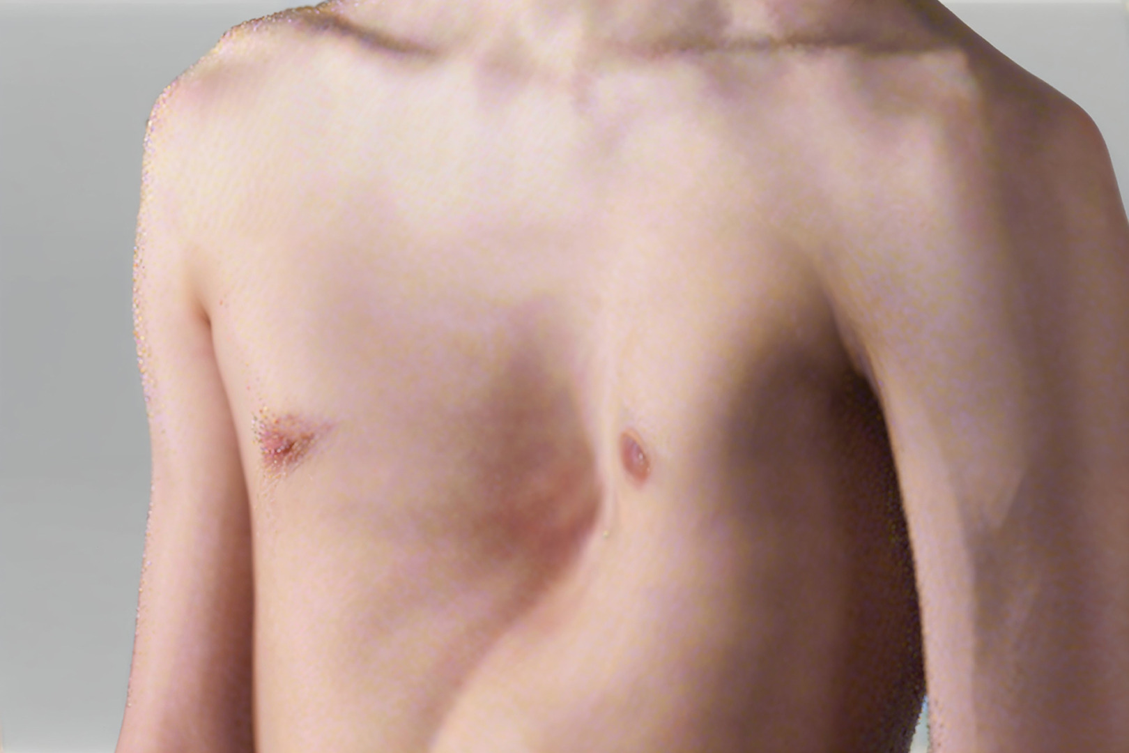 sunken upper chest treatment