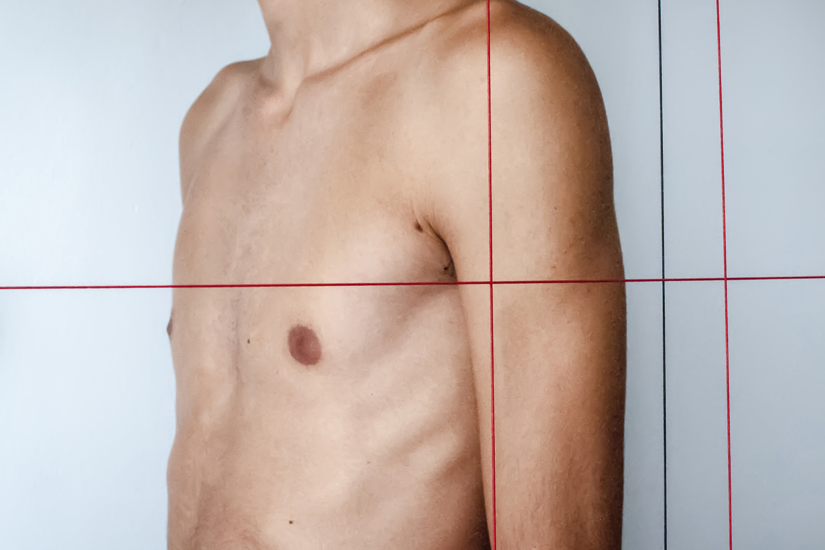 sunken upper chest