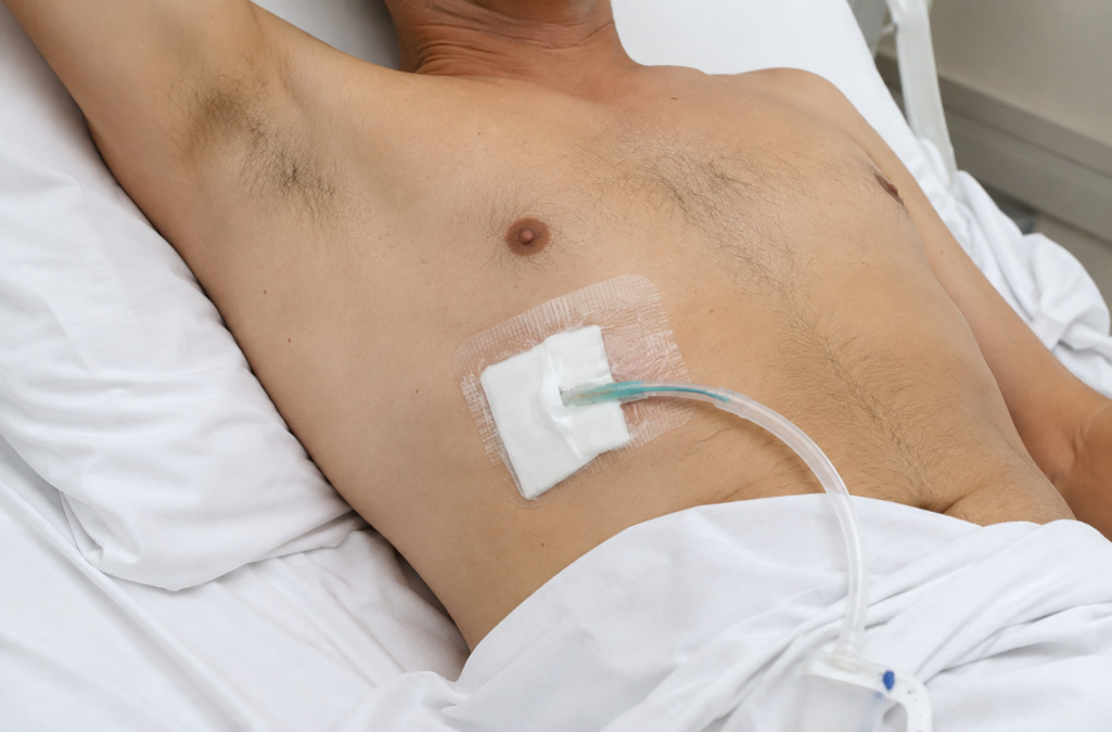 talc pleurodesis recovery
