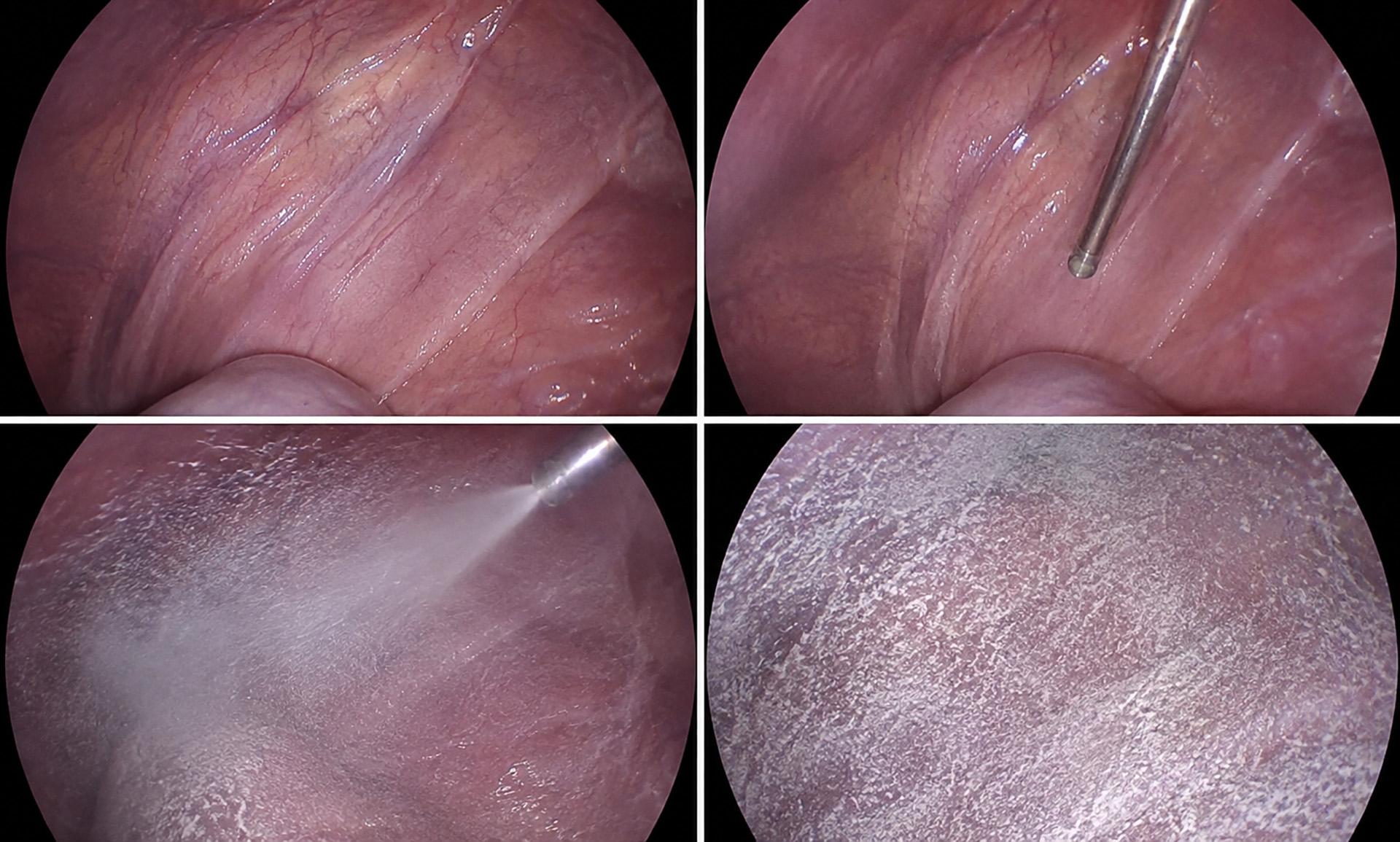 talc pleurodesis