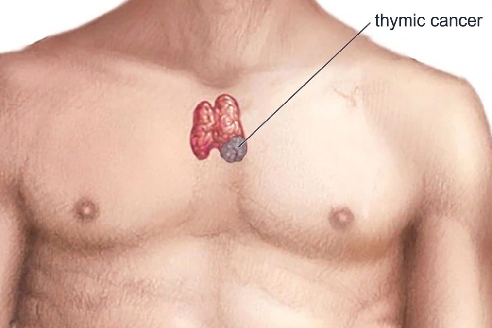 thymic cancer