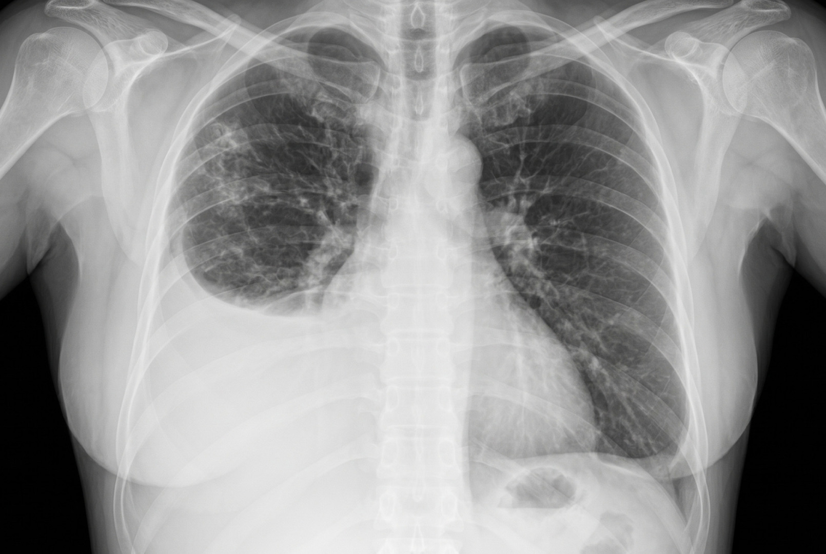 transudative pleural effusion causes