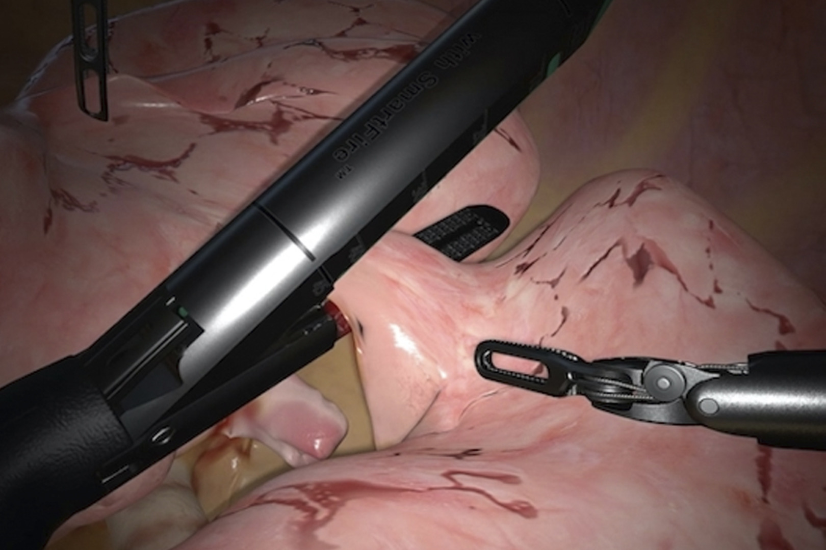 types of lung surgery
