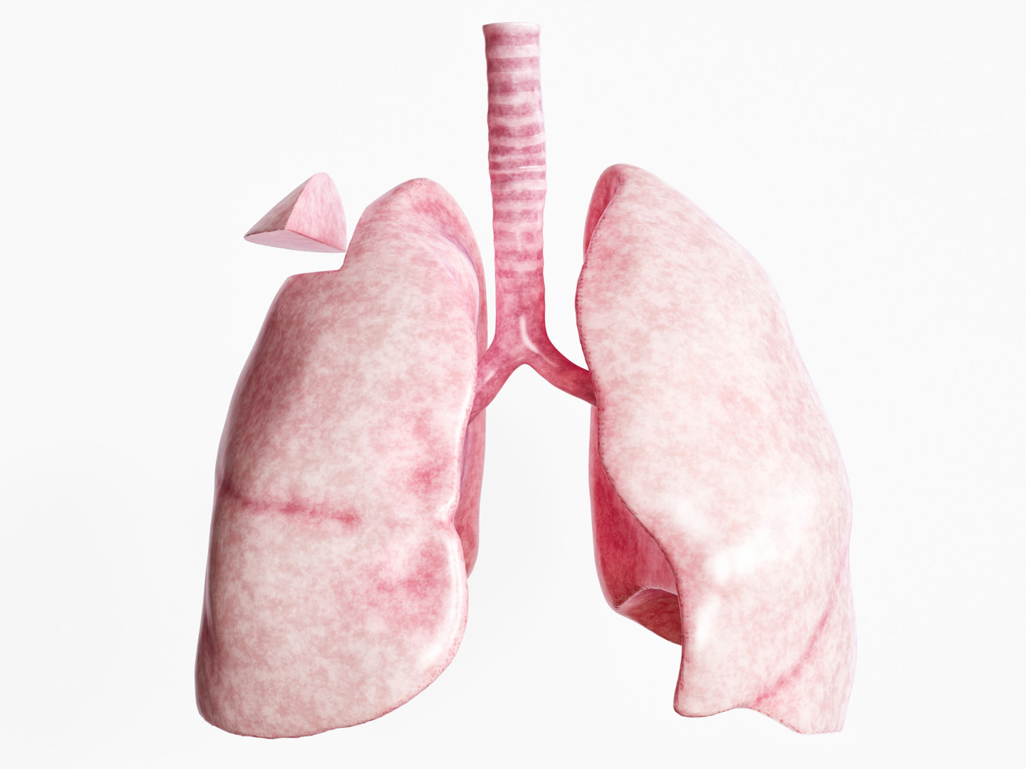 wedge resection lung