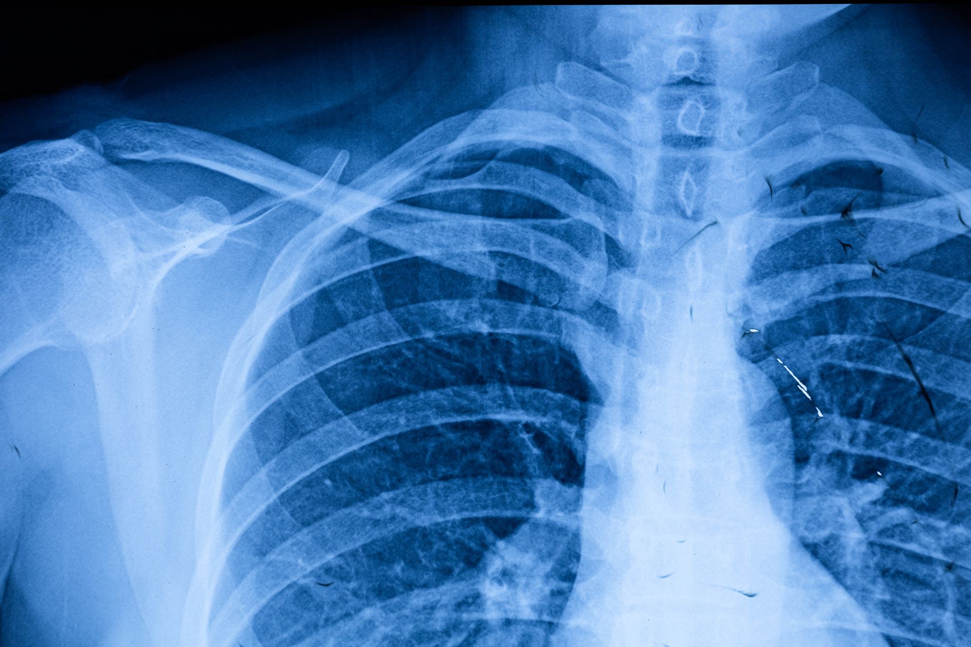 Beyond the Trauma of a Buckle Rib Fracture to Expert Recovery