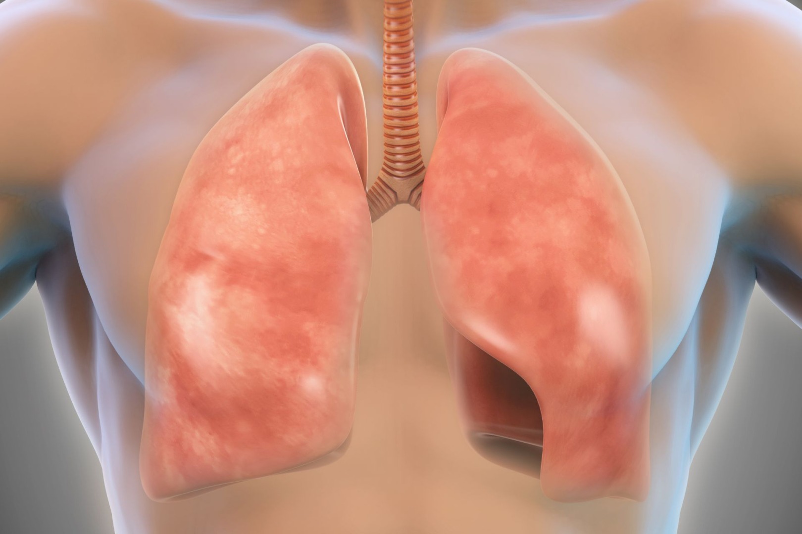 what is pneumothorax