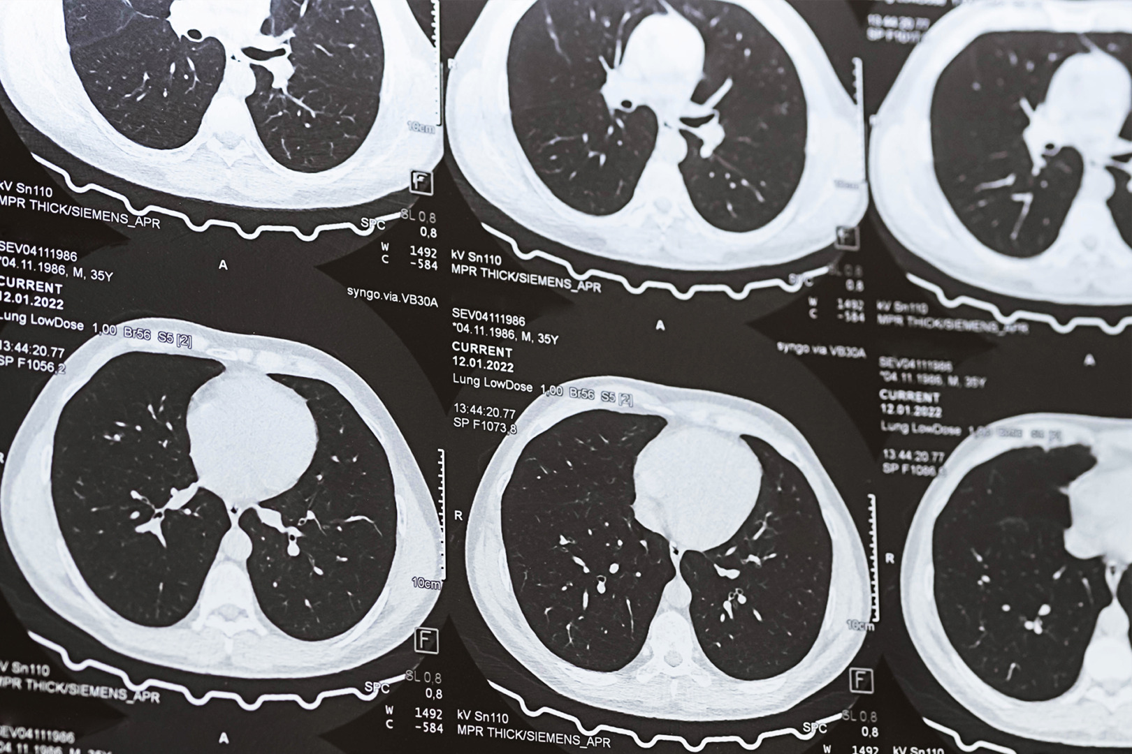 when to be concerned about a lung nodule