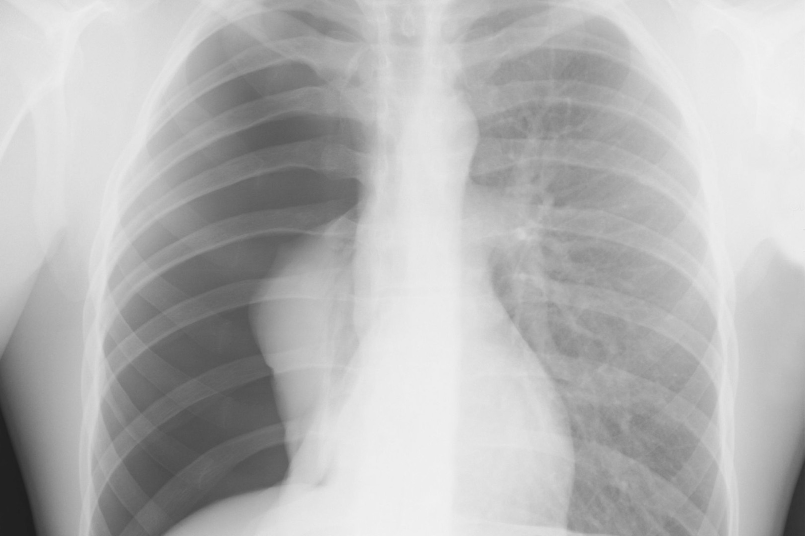 xray of pneumothorax